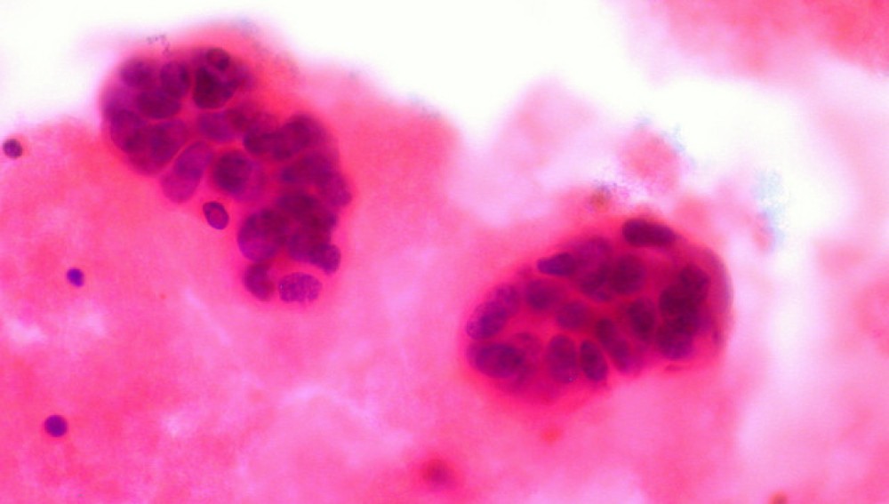 Descubrieron una técnica para detener la metástasis en enfermos de cáncer | Internacionales