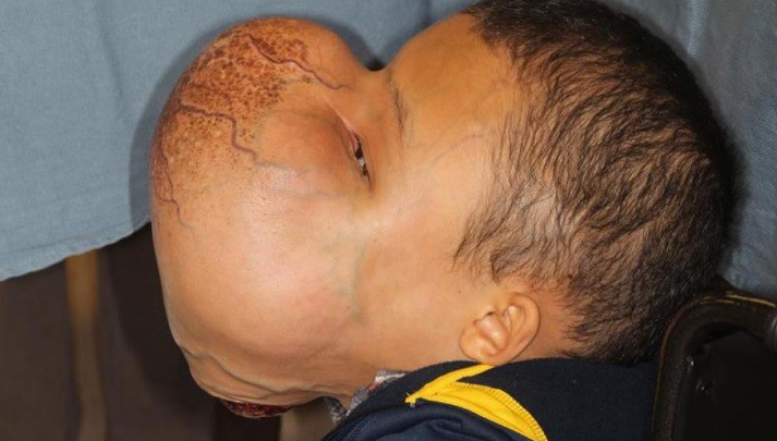 Cirujanos de Miami extirparán este tumor facial de 4,5 kilos a un niño cubano | Internacionales