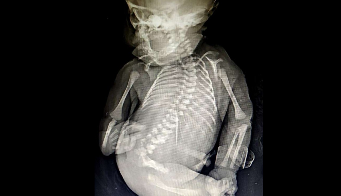 Una mujer dio a luz a un "bebé sirena" que sólo vivió quince minutos | Internacionales