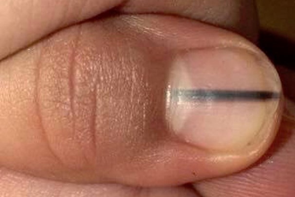 Fue a la manicurista y le descubrió cáncer | Redes