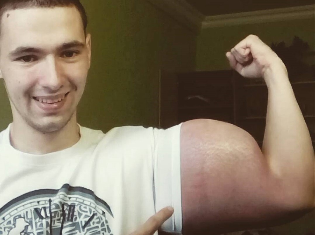 El "Popeye" ruso: se inyecta aceite en los brazos para romper récords | Redes