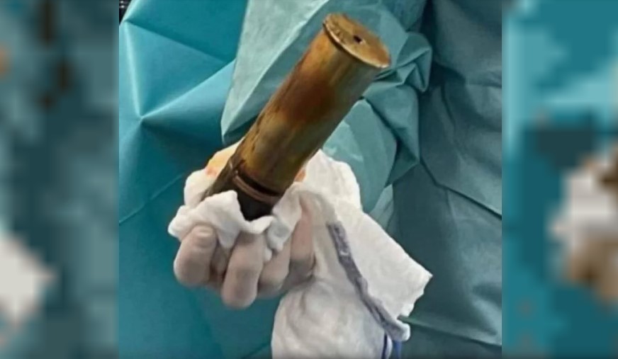 Evacúan hospital en Toulouse por proyectil de la Primera Guerra Mundial alojado en un paciente | Internacionales