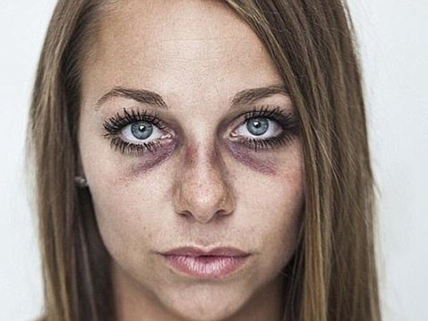 Tras recibir una paliza de su ex pareja mostró sus terribles heridas en Facebook para concientizar sobre la violencia doméstica | Actualidad