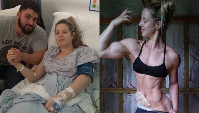 Estuvo cerca de morir, le colocaron una bolsa de colostomia y ganó un torneo de fisicoculturismo | Curiosidades