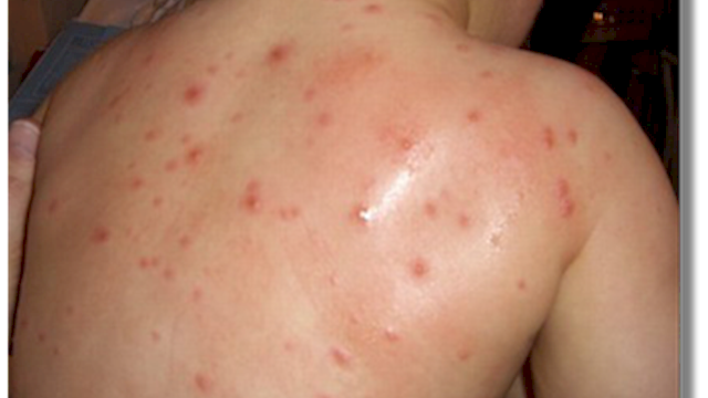 Murió un nene de 4 años afectado por varicela | Actualidad