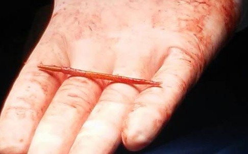 Operación inédita: le sacaron del corazón un escarbadientes que se tragó en una picada | Curiosidades