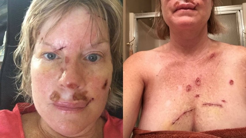 La mujer que mostró su lucha contra el cáncer de piel y conmocionó a las redes sociales | Redes