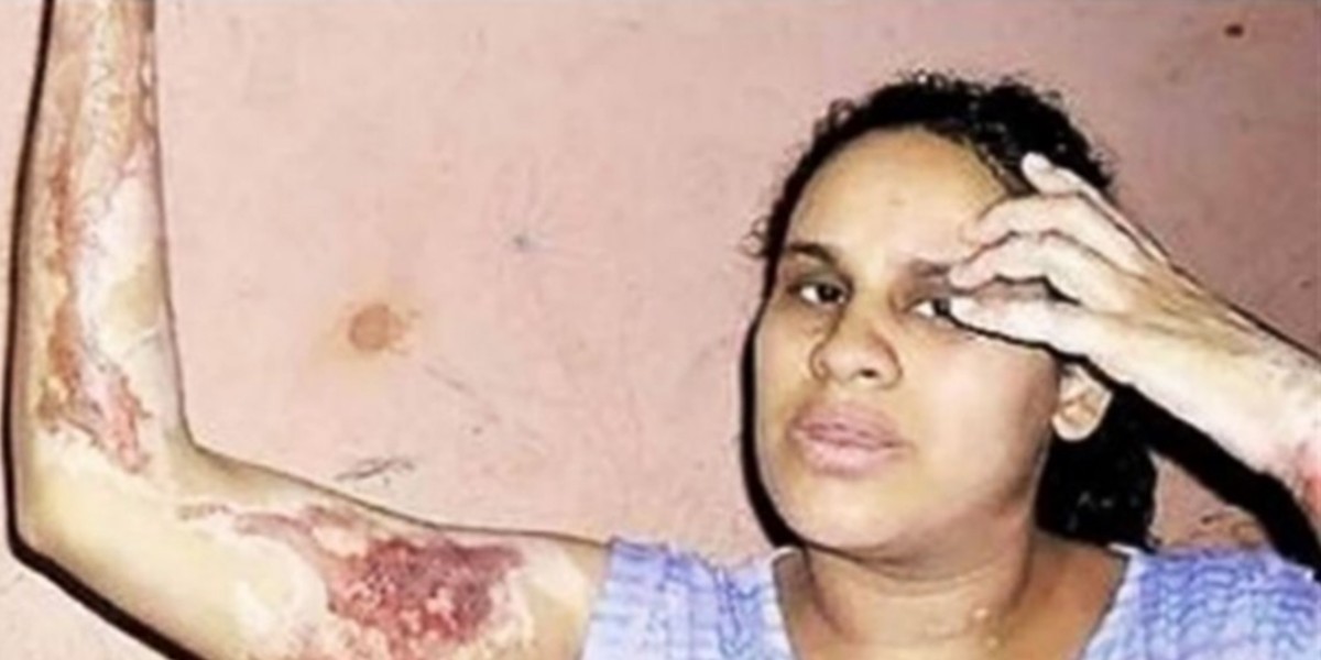 Ex director del INADI prendió fuego a su pareja, quedó libre y le volvió a pegar | Actualidad