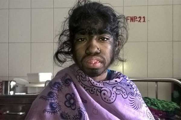 El drama de la nena que padece "síndrome de lobo" en Bangladesh | Curiosidades