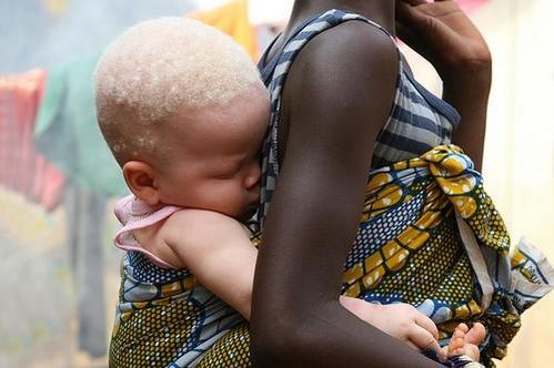 Crece la matanza de albinos en África: mezcla de brujería y superstición | Internacionales