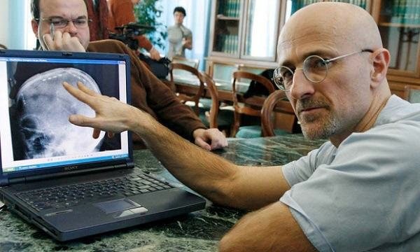 Anuncian dónde se realizará el primer trasplante de cabeza | Internacionales