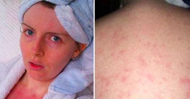 La historia de la mujer que no se puede bañar porque tiene alergia al agua | Curiosidades