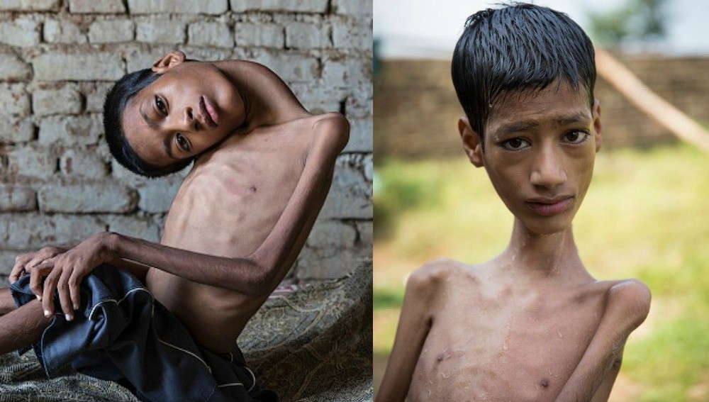 Fue operado con éxito el chico que tenía el cuello colgando | Curiosidades