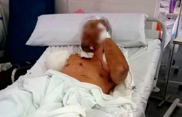 Le amputaron un brazo a un ladrón que fue atacado por un perro pitbull | Actualidad