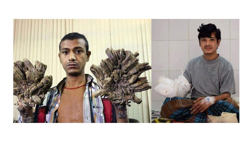 Esperan dar el alta en un mes al "hombre árbol" | Internacionales