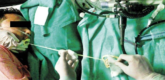 India: médicos extraen por la boca de un paciente una lombriz solitaria de 1,85 metros | Curiosidades