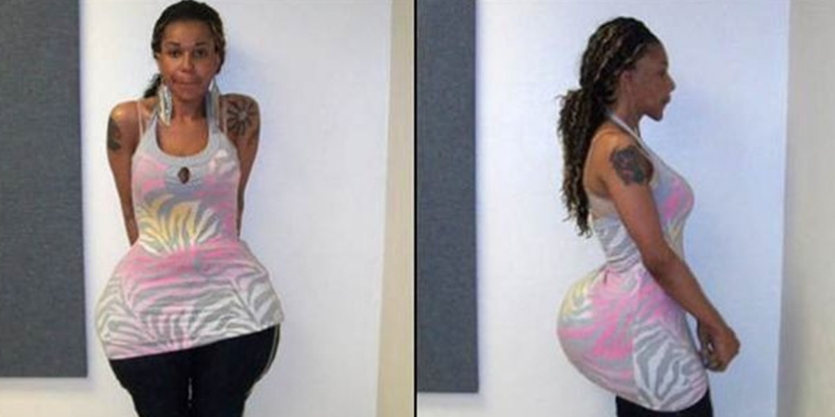 EE.UU.: condenaron a una falsa médica por aumentar glúteos con cemento y pegamento | Internacionales