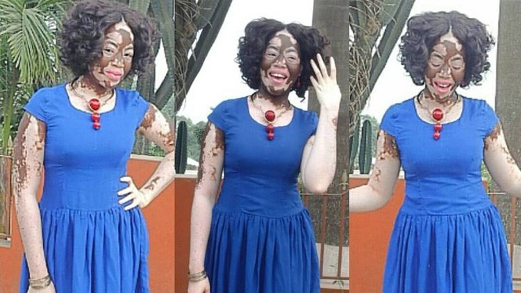 La chica que tiene vitiligo, superó el bullying y se convirtió en modelo | Curiosidades