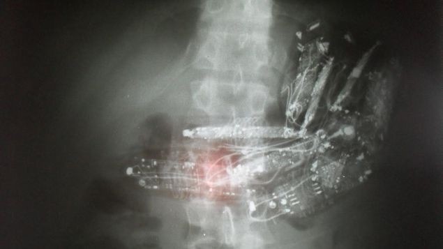 Descubrieron a tres presos con 19 celulares en el estómago y el recto | Internacionales