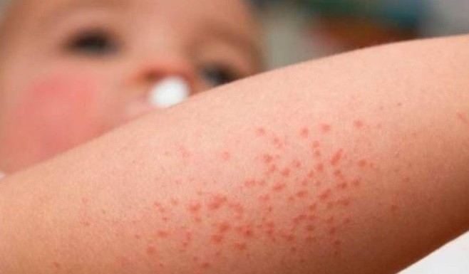 Primera campaña sobre la "dermatitis atópica", la segunda enfermedad de la piel más diagnosticada | Actualidad