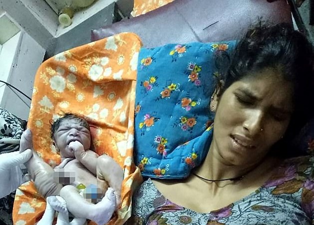 India: el bebé que nació con cuatro piernas y dos penes | Curiosidades