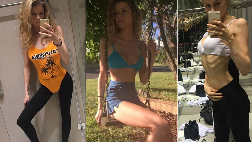 La joven que sufrió anorexia y cuenta su calvario: "Era recuperarme o morir" | Internacionales