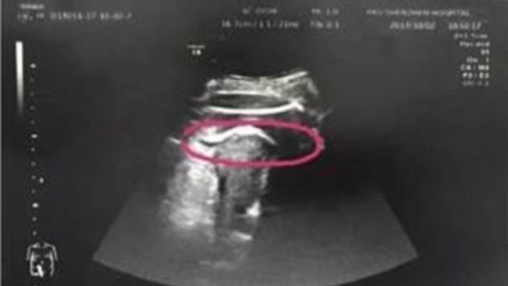 Una mujer estuvo a punto de morir luego de que su bebé le perforó el útero de una patada | Internacionales