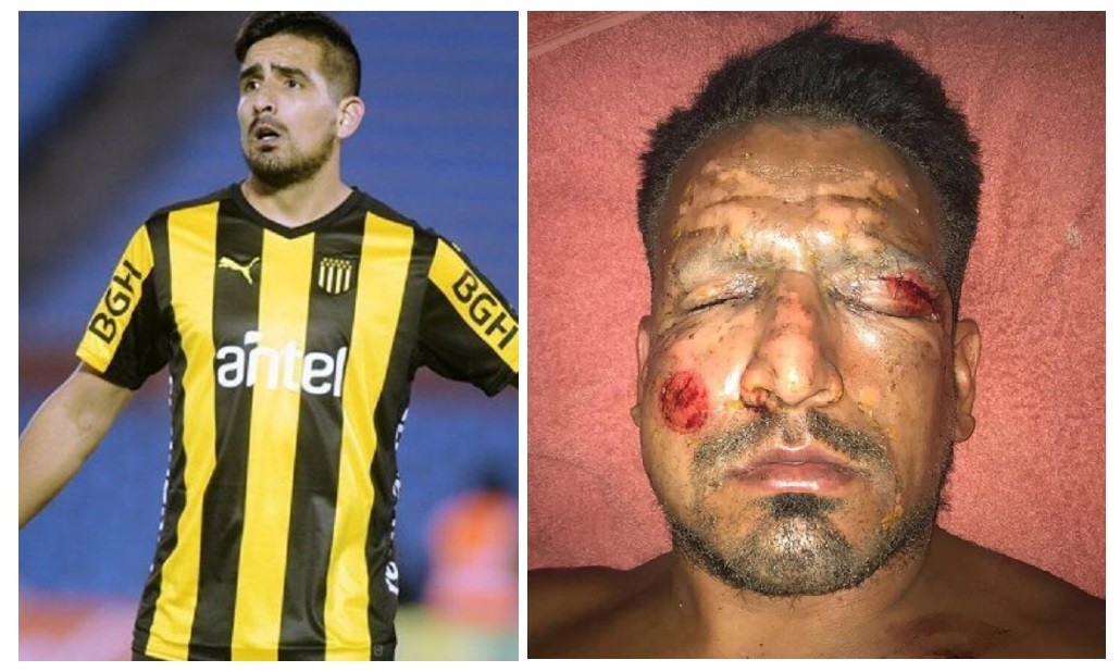 Dos meses de recuperación tendrá Lucas Viatri tras el accidente con pirotecnia | Deportes