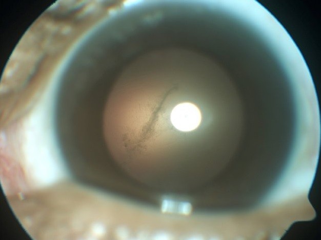 Le sacaron del ojo un gusano "come cerebros" | Internacionales