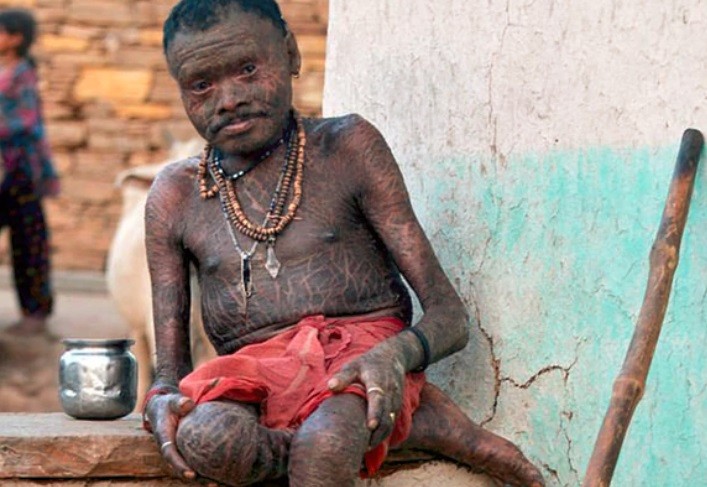 El extraño caso del “hombre serpiente” que cambia la piel cada 10 días | Curiosidades