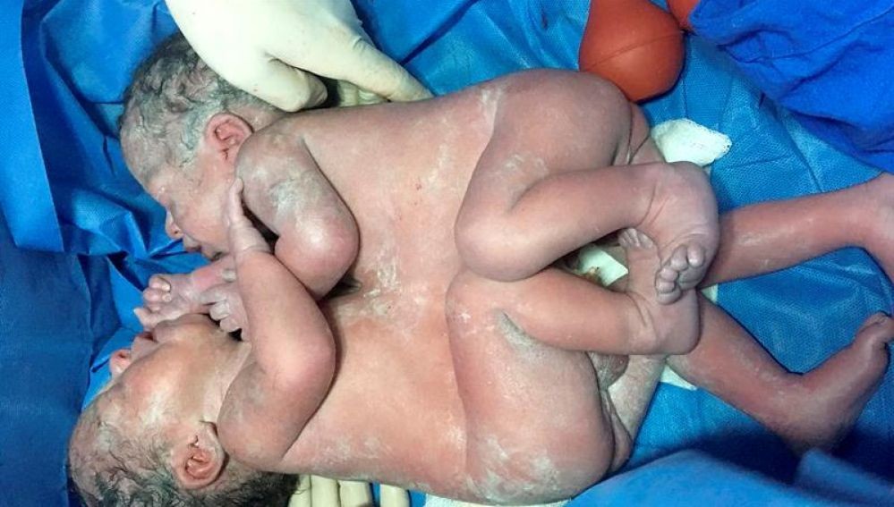 Separaron con éxito a siameses unidos por el tórax y el abdomen | Internacionales