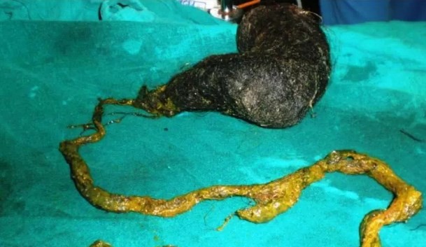 India: una nena fue internada por dolores de panza y le extrajeron del estómago dos kilos de pelos | Curiosidades