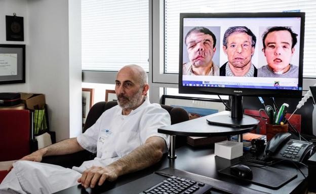 Trasplante inédito: el hombre de las tres caras | Internacionales