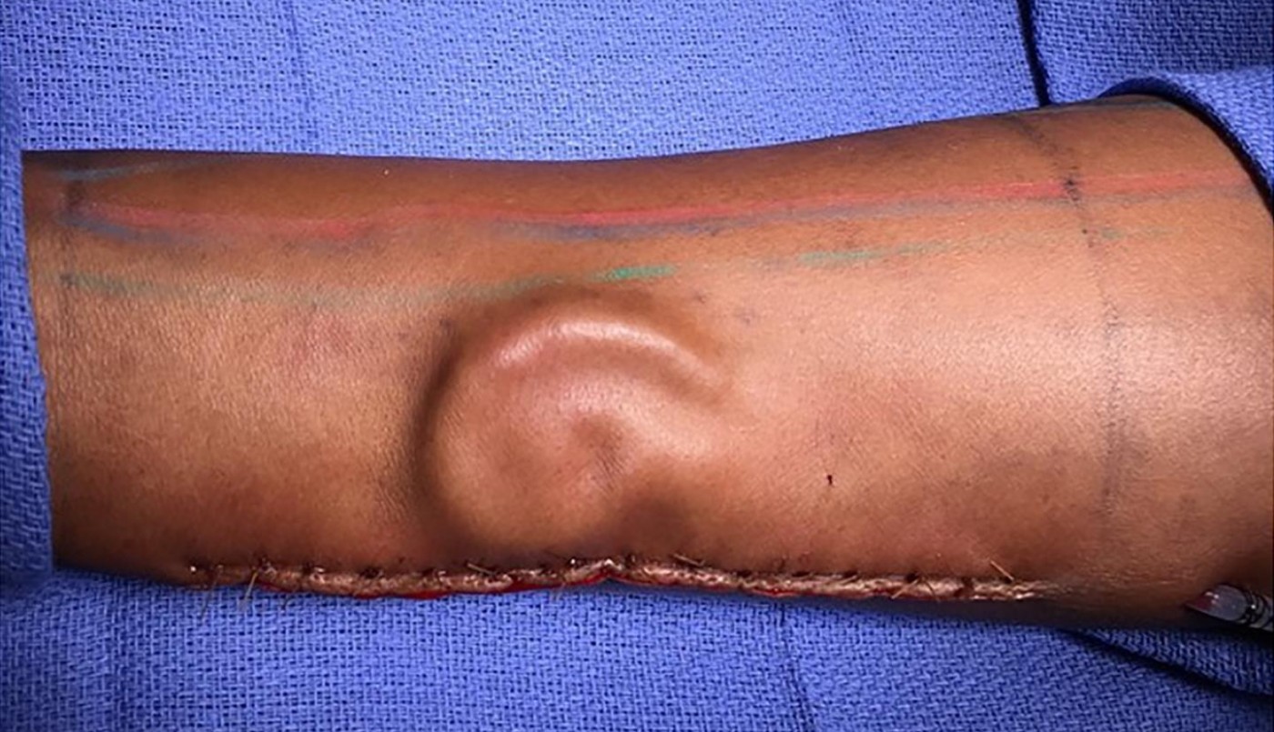 Le hicieron crecer una oreja en el brazo y se la trasplantaron a la cabeza | Internacionales