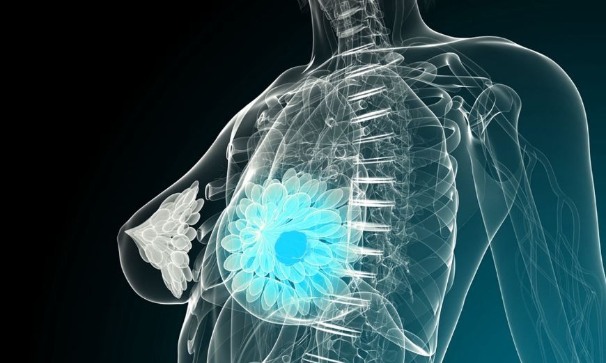 Estados Unidos: consiguen eliminar una metástasis de cáncer de mama por primera vez | Internacionales