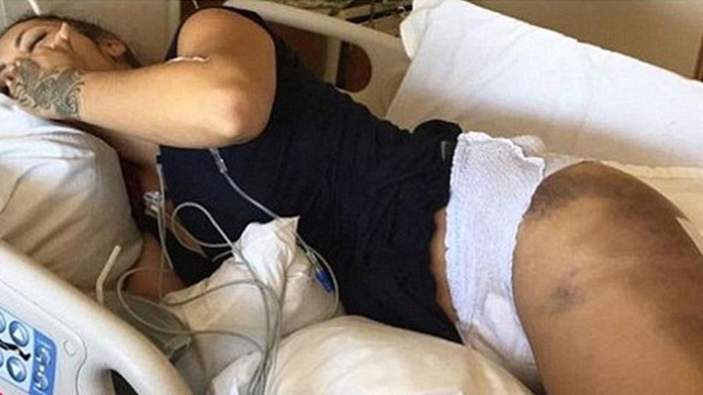 El calvario de una mujer tras inyectarse siliconas en los glúteos | Internacionales