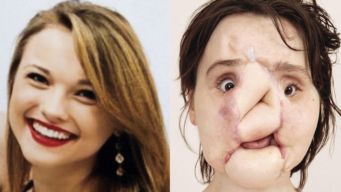 La historia de la mujer más joven en recibir un trasplante de cara | Internacionales