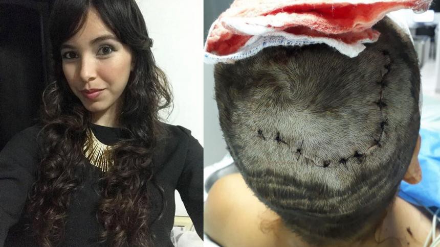 Colombia: un hombre le arrancó el cuero cabelludo a su ex pareja | Internacionales