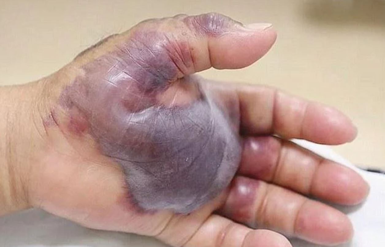 Le agarró una infección por comer sushi y tuvieron que amputarle el brazo | Curiosidades