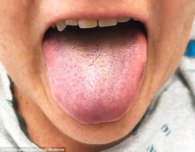 Un antibiótico hizo que mutara su lengua: se le puso negra, peluda y con mal olor | Curiosidades