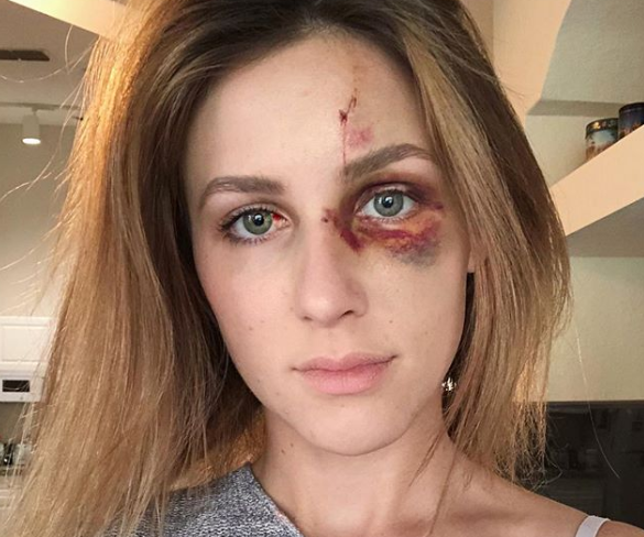 Un campeón de motocross golpeó brutalmente a su novia tras quejarse por una foto que subió a Instagram | Internacionales