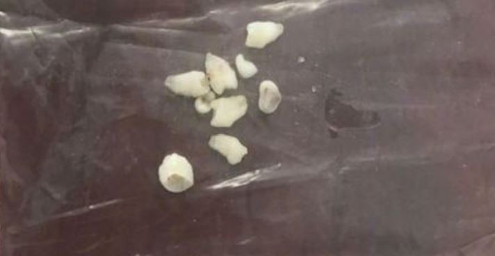 Extraen dientes sueltos del cerebro de un nene de 5 años | Curiosidades