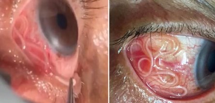Impresionante: un hombre tenía un gusano vivo en el ojo | Curiosidades