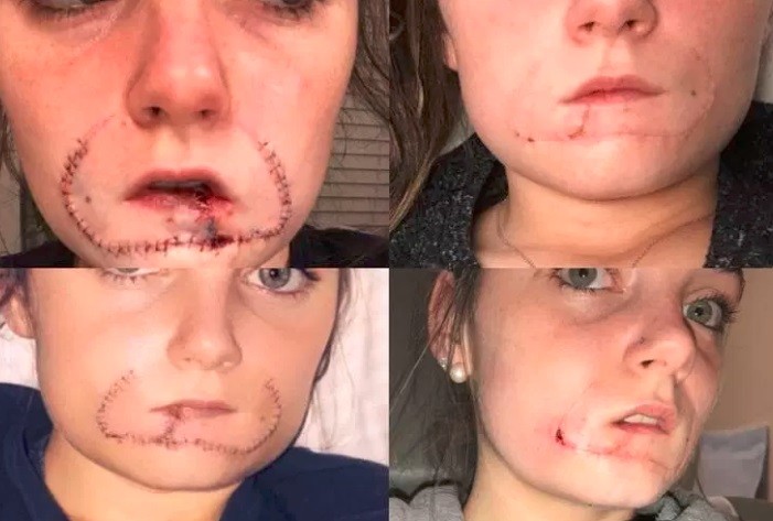 Le arrancó ellabio a su ex novia porque no quiso darle un beso | Internacionales