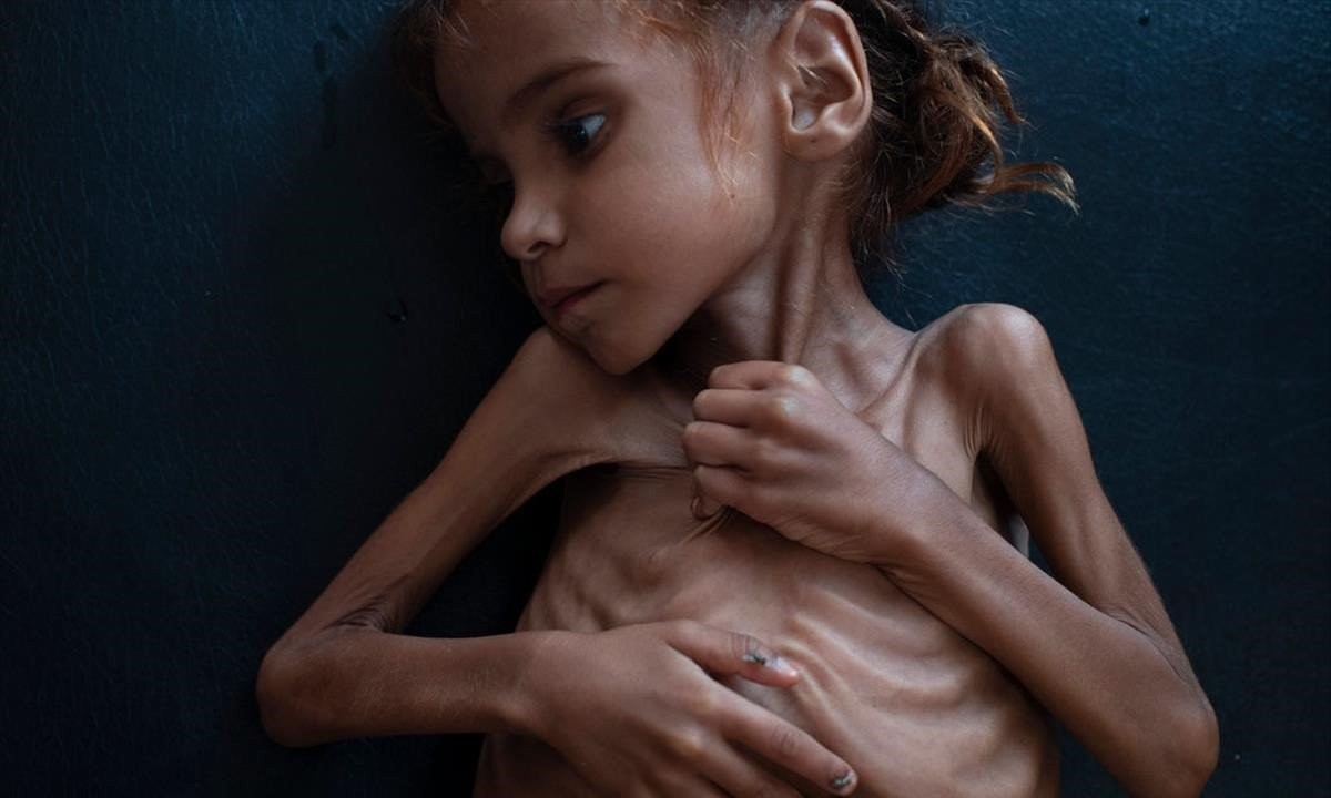 Murió Amal, la nena símbolo de la hambruna de Yemen | Internacionales