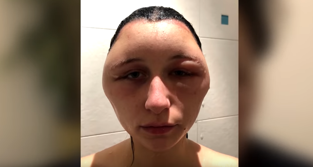 Se tiñó el pelo y terminó con la cabeza totalmente deformada: "Casi muero" | Redes