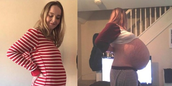 Los doctores pensaron que estaba embarazada, pero tenía un quiste de 26 kilos | Curiosidades