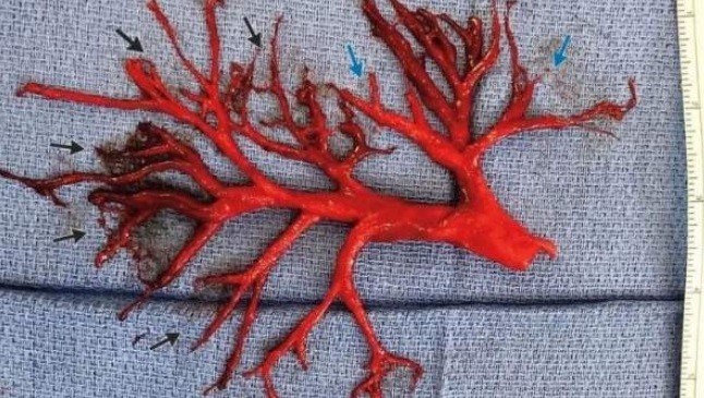 El increíble coágulo de sangre que tosió un paciente en Estados Unidos | Internacionales