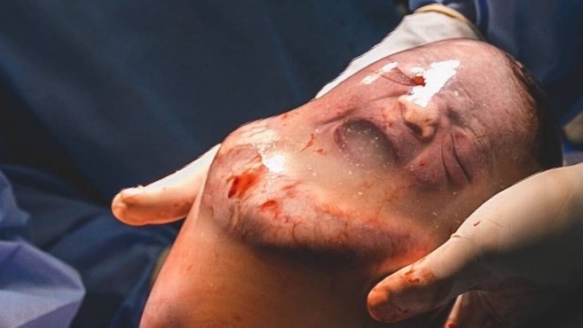 El increíble parto de un bebé que nació dentro del saco amniótico y sobrevivió | Curiosidades