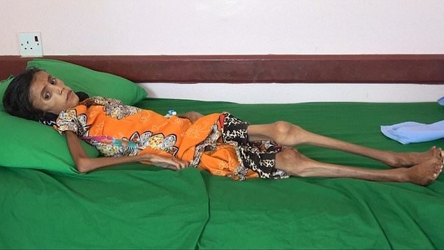 La nena que pesa 10 kilos yse volvió símbolo de la hambruna de Yemen | Internacionales